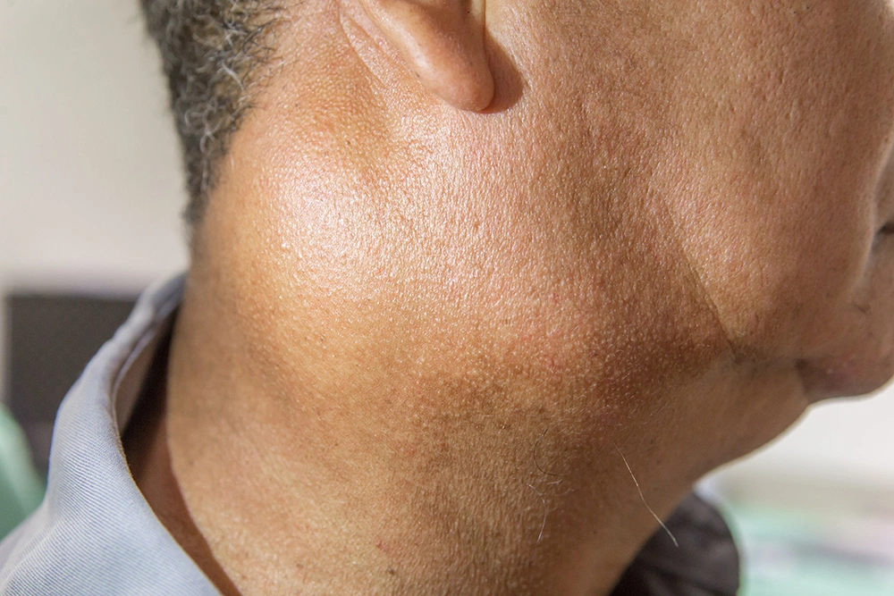 Man with a neck lump from lymph node enlargement.